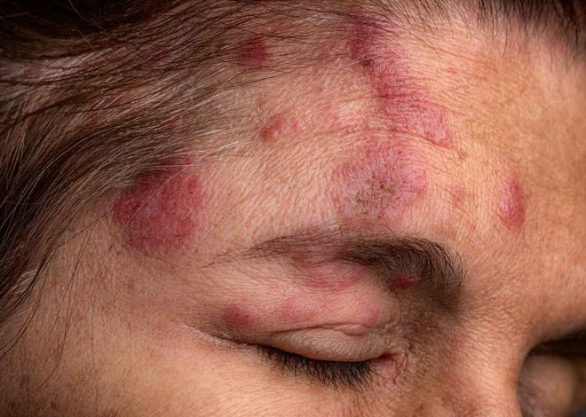 Why do I get the herpes zoster vaccine as fast as possible